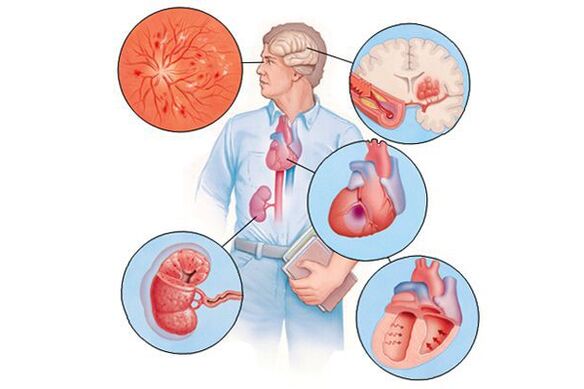 Damage to various organs during long-term arterial hypertension